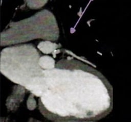 X-ray of LAD Soft Plaque