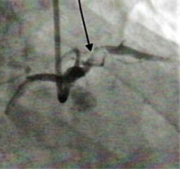 X-ray of LAD Stenosis