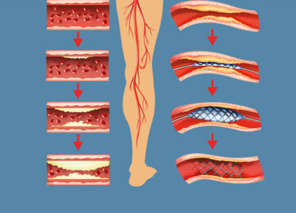 Graphical View of Leg Nerves Stock Image