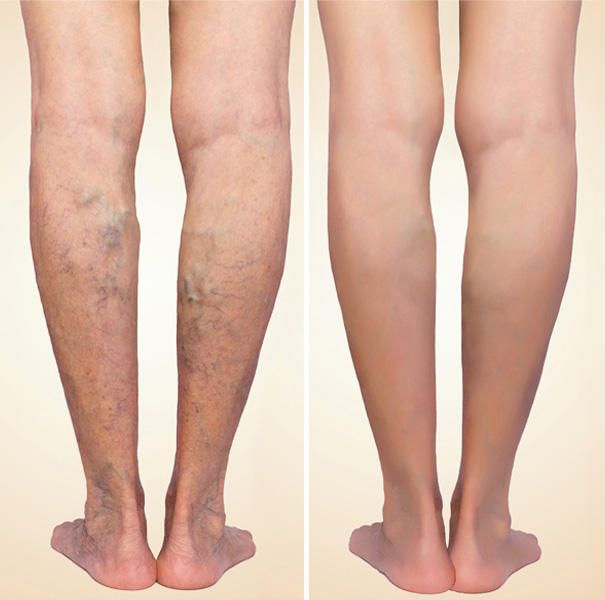 Before & After Photo of Spider Veins