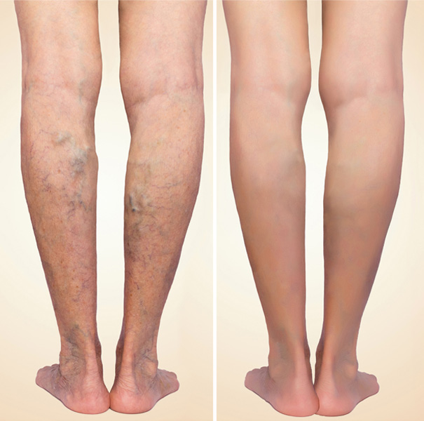 Varicose Veins Treatment Beverly Hills