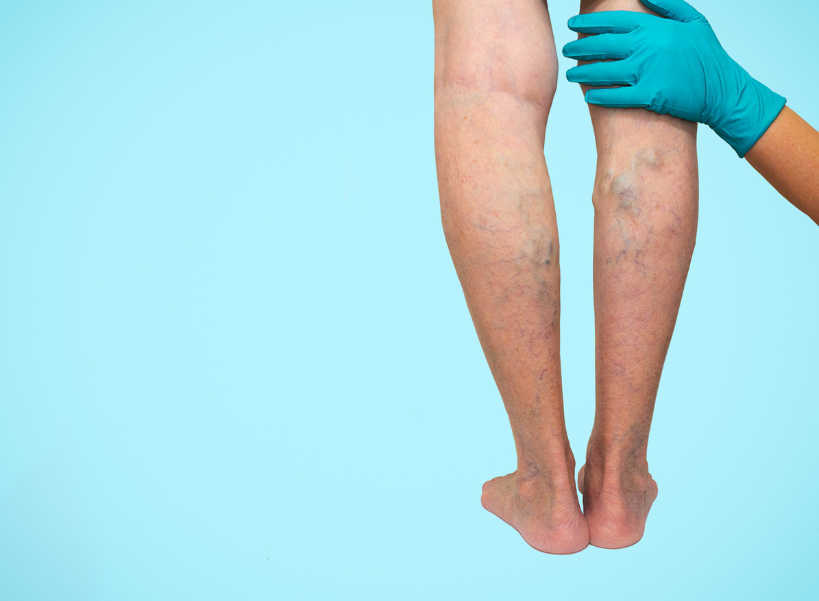 Effective Treatment for Varicose Veins