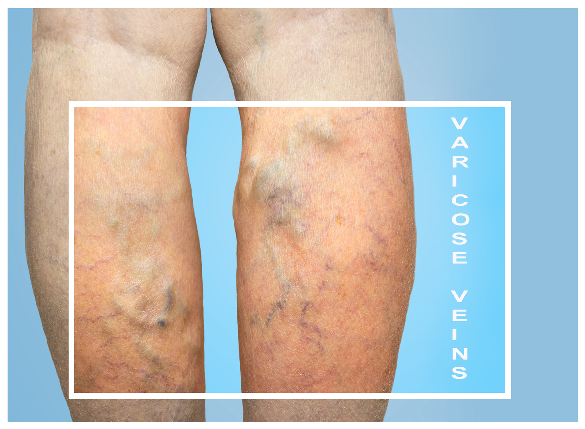 are varicose veins dangerous