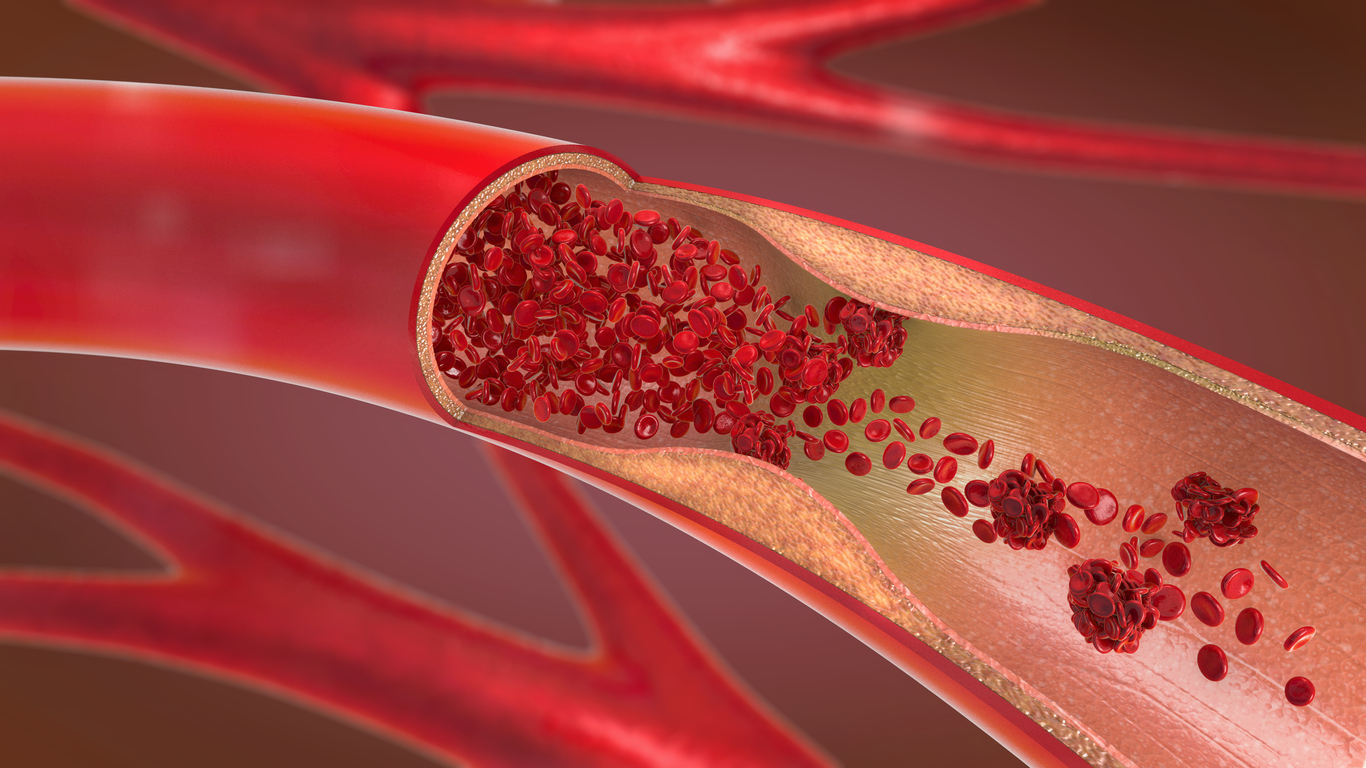 Constricted artery diagram