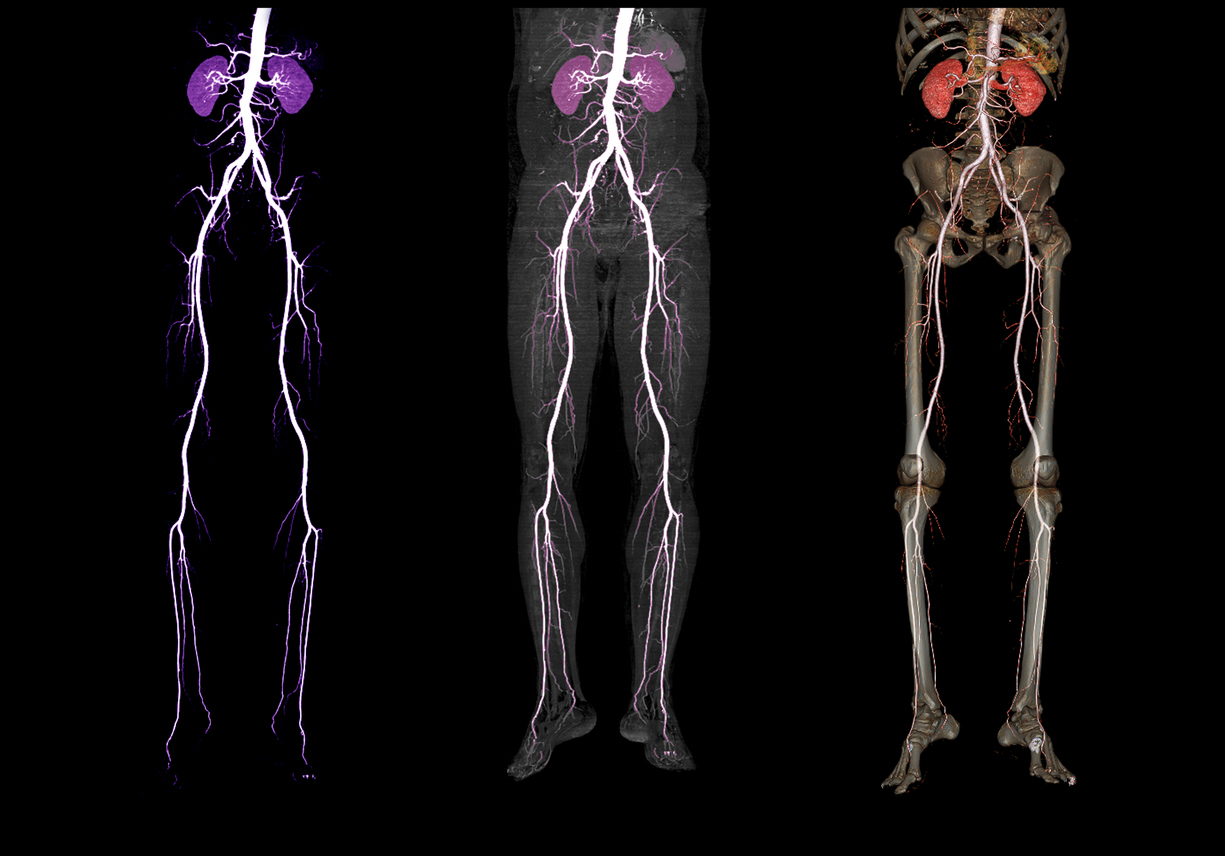 Smoking and Peripheral Artery Disease