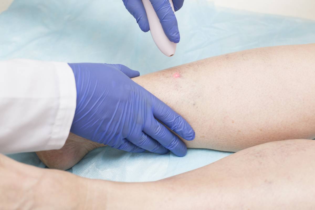 Is laser treatment painful?