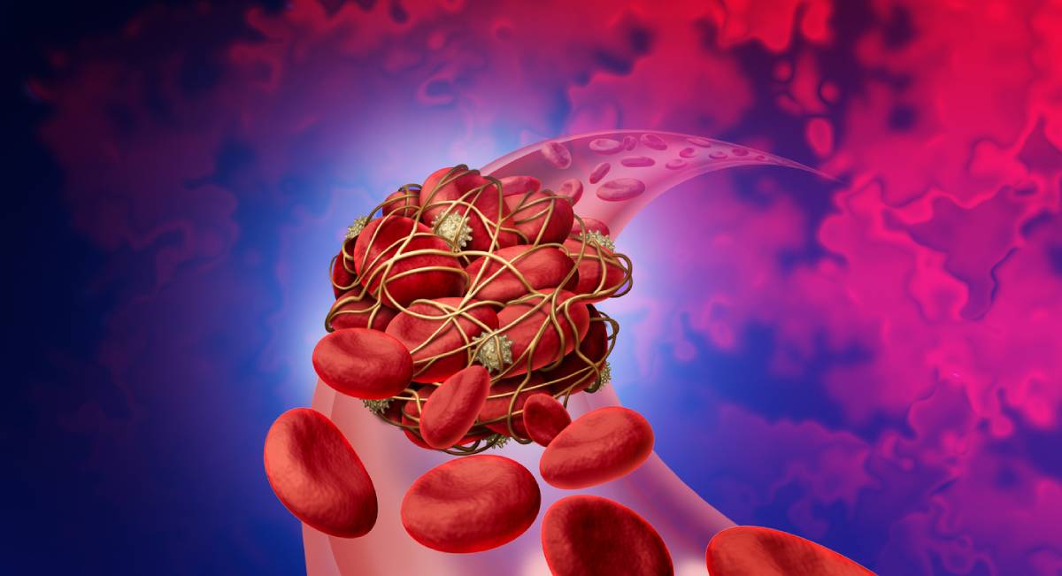 Concept image of deep vein thrombosis