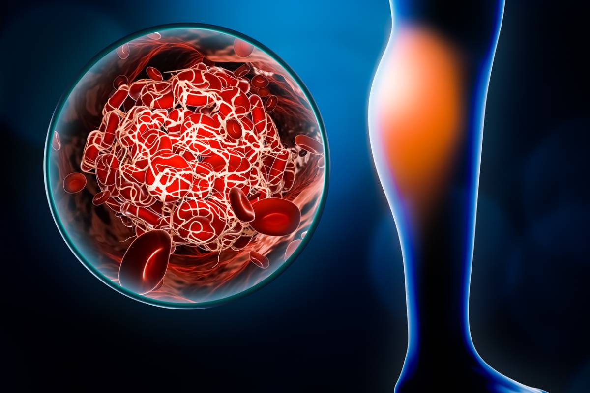 concept of lifestyle-related thrombosis risks