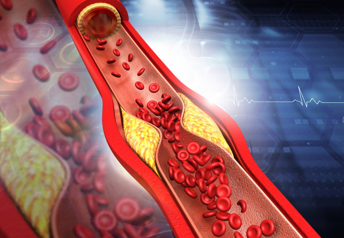 concept of warning signs of blocked arteries