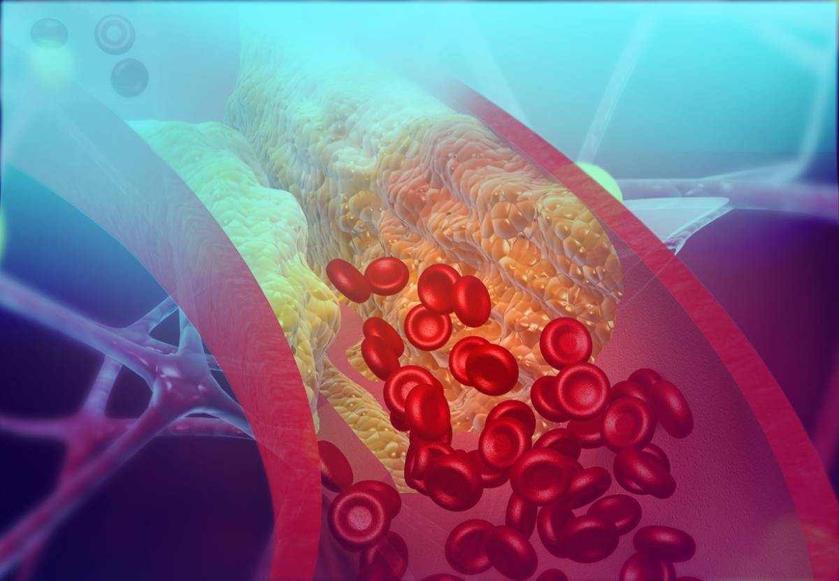 example of results after life with worst habits for your arteries