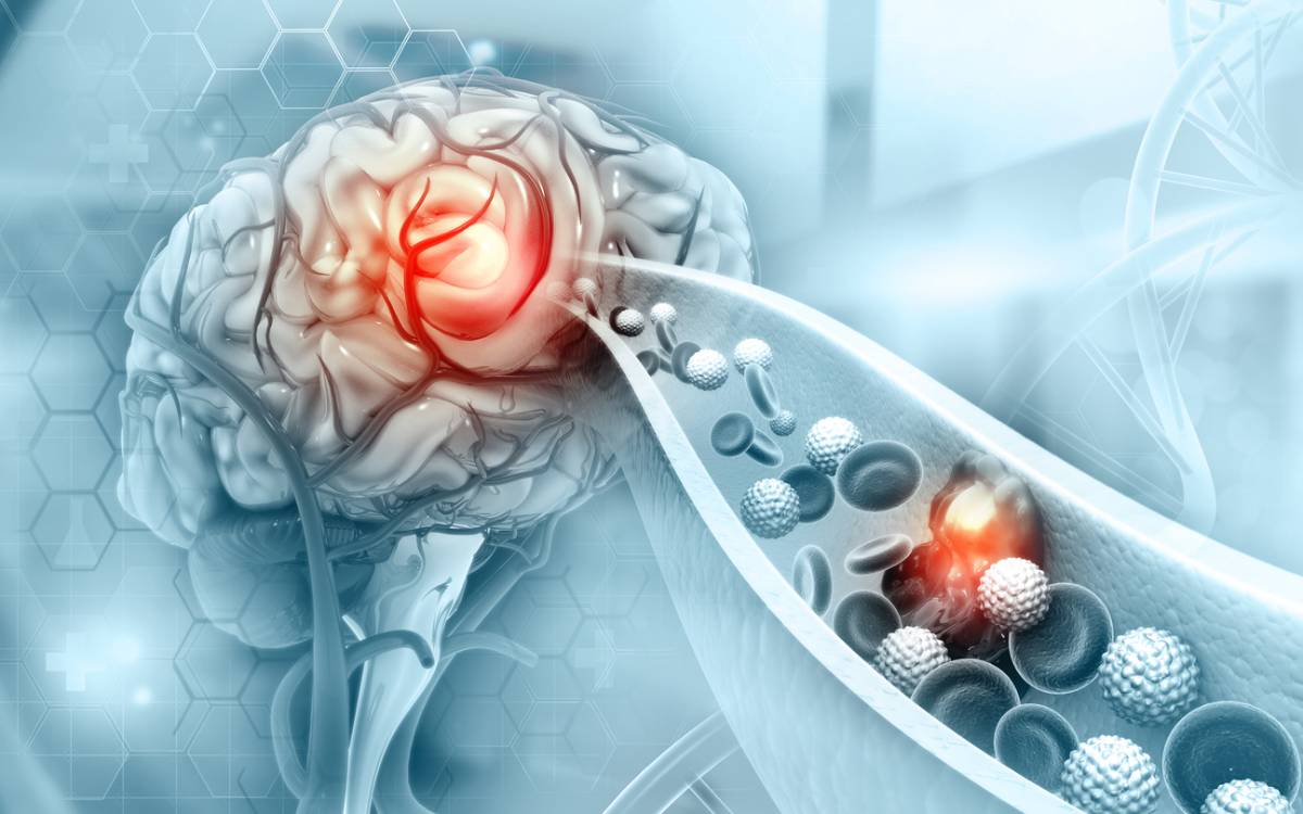 featured image for top risk factors for ischemia