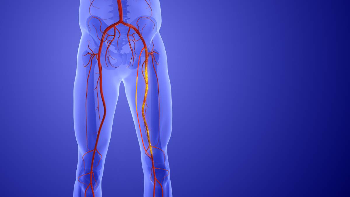Featured image for Can You Reverse Peripheral Artery Disease