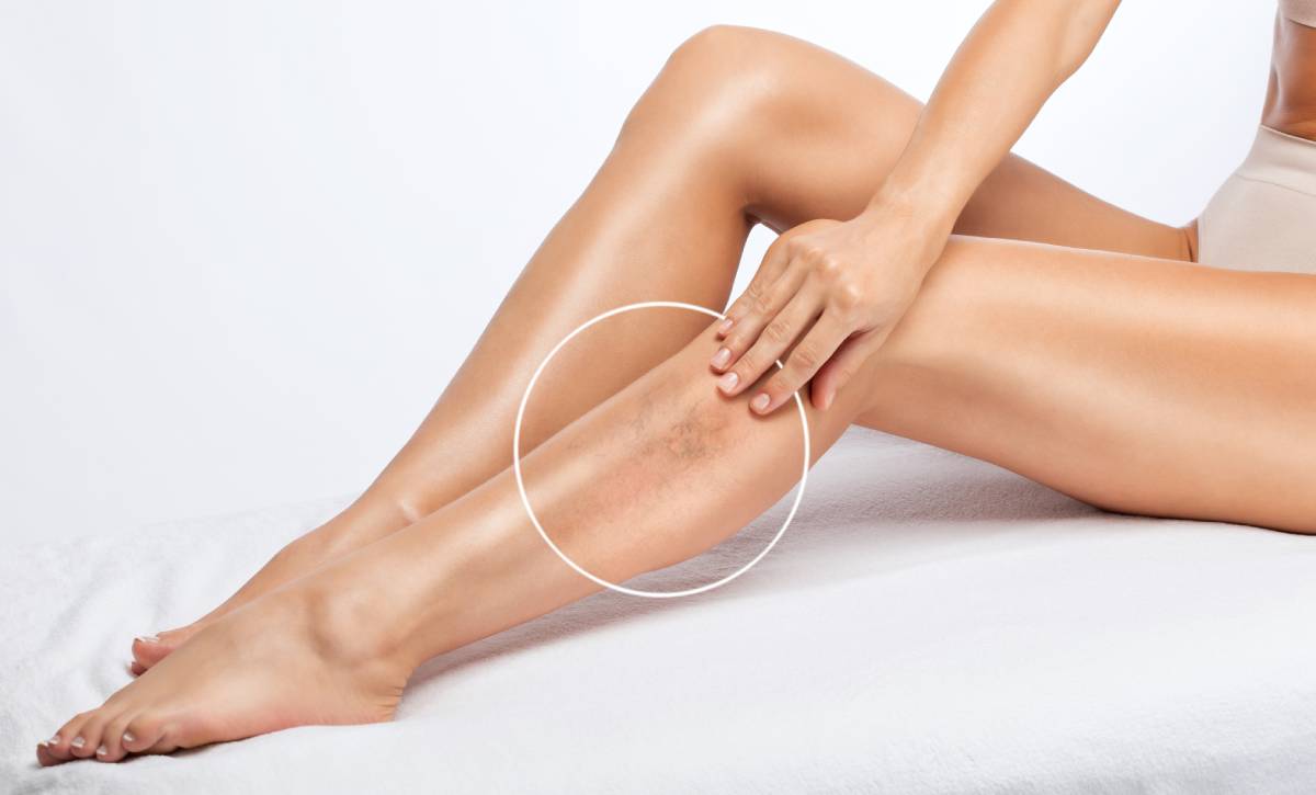 Woman revealing spider veins on leg.